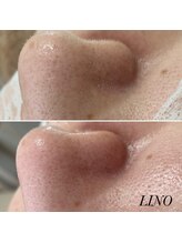 リノ(Lino)/毛穴ケア