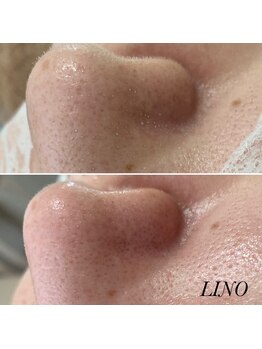 リノ(Lino)/毛穴ケア