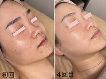 エイプリルフールズ(April fools)/【20代】ブライダルエステ♪