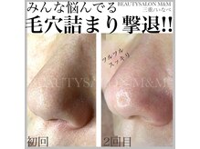 エムアンドエム(M&M)/毛穴改善！