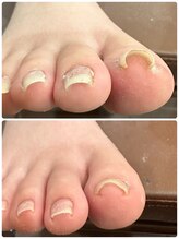 ゾゾ イリプレッセブル(ZOZO irreplaceable)/巻爪補正