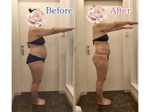 メディカルエステサロン ローズ 高岡店(ROSE)/痩身ビフォーアフター