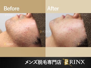 リンクス 松山店 愛媛(RINX)/ヒゲ脱毛《メンズ脱毛RINX》
