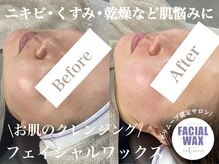 エミュ(emu)の雰囲気（継続することでお肌が綺麗に#マリムーブフェイシャルワックス）