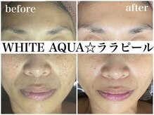ホワイトアクア 梅田本店(WHITE AQUA)/ララピールでたまご肌が叶う！