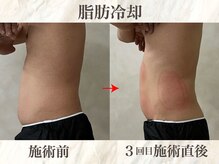 ウィボーテ(We Beaute)/【痩身】脂肪冷却×脂肪分解