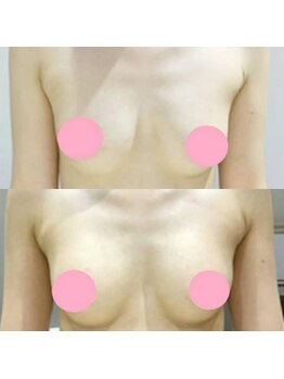 九美院/バストアップ／下垂／左右差