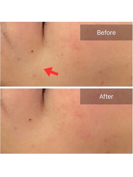 ビビ(VIVI)/ララピールは小ジワにも◎