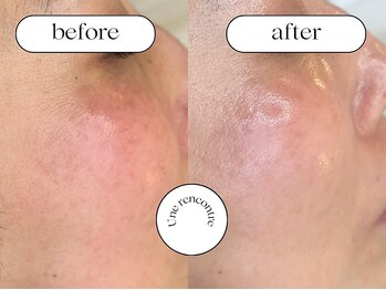 ユヌランコント 岐阜店(Une rencontre)/ジュエリーピーリング