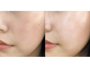 美的アヴェニール(美的.Avenir)の写真/毛穴の開き・引き締め・トーンアップ☆
気になる箇所、徹底ケア!!