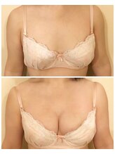 リール 恵比寿店(RIRE)/バストアップ症例【広尾恵比寿】