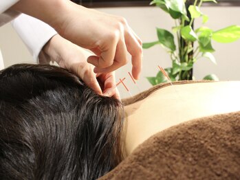 立川レディース鍼灸マッサージ はるはる/手の届きにくい場所に鍼