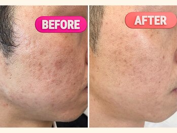 パッパ(PAPPA)/光フェイシャル3回の変化