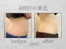 アンビーユー(ANBE.U)/腸もみビフォーアフター