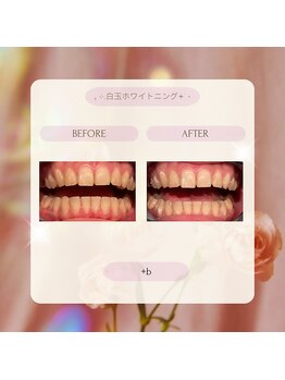 プラスビー 2号店(+b)/ホワイトニングビフォーアフター