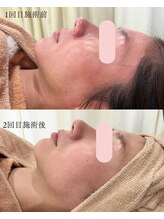 シンナリ(Shinnari)/症例：肌管理施術（肌質改善）