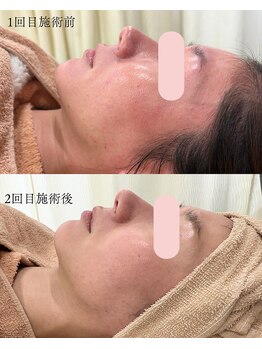 シンナリ(Shinnari)/症例：肌管理施術（肌質改善）