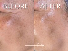 神門 メディカルラボ MEILI院(MedicalLab)/40代 | 女性 | ハーブピーリング