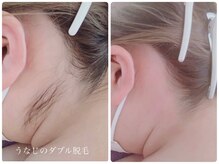 サロン ド モア(salon de MORE)/うなじのダブル脱毛