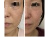 【毛穴の開き・詰まり】毛穴にまつわるお悩みが深刻な方