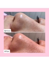 ホワイトラボ 岸和田店(White labo)/【施術例】ハイドロ毛穴洗浄