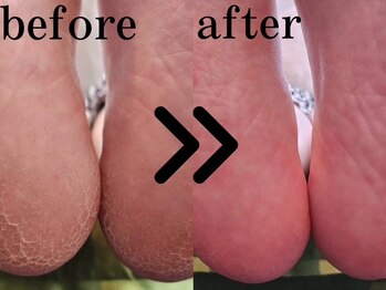 リノ(Lino)/足裏角質除去