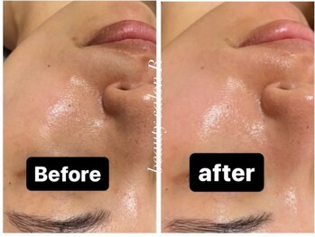 ビューティサロン アール(R)/紫外線でくすんだお肌も改善