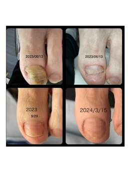 ナチュエイド/厚い爪・変形爪