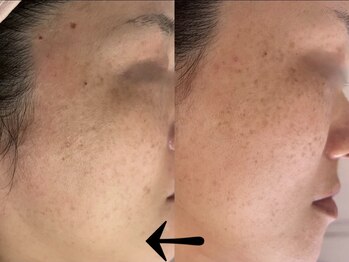 サロン ドロップ 上小田井(Salon drop)/「シミ改善」途中経過