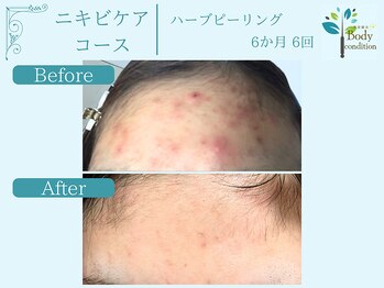 ボディコンディション/ハーブピーリング/毛穴洗浄/小顔