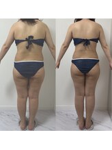 プリマルーチェ/脂肪冷却