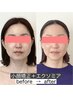 【印象改革】顔を整え、肌まで育てる!小顔矯正+エクソミア 初回14800円