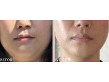 ロジワール(LOISIR)/顎下フェイスラインの変化