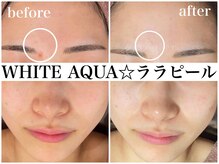 ホワイトアクア 梅田本店(WHITE AQUA)/ララピールでニキビケア★梅田
