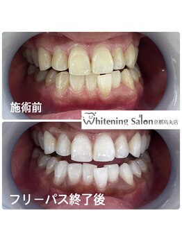 ホワイトニングサロン 京都烏丸店/ホワイトニング施術例