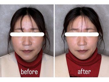 ウル 名駅(ulu)/美容鍼のビフォーアフターです♪