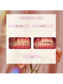 プラスビーセルフ(+b self)/ホワイトニングビフォーアフター