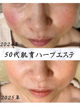 サロン ド エン(Salon de. en)/肌荒れケア◇ハーブピーリング