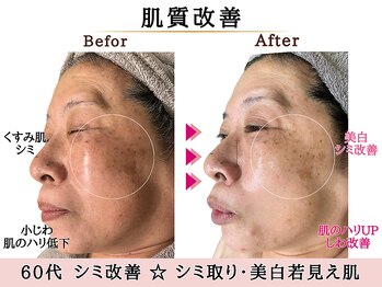 グレースエール トータルビューティーサロン(Grace Aile)/肌質改善