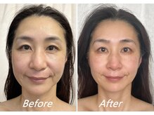 頬のたるみ、片側に強く出たほうれい線、鼻のむくみ、長さを改善