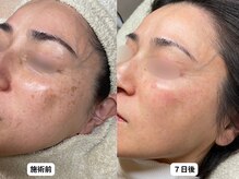 エングラッシー(en glassy)/BEFORE　AFTER　最新シミ回収