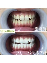 ルブラン 奈良店(Le Blanc)/夏こそホワイトニング！