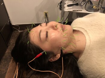 ロミハリ(LomiHari)/美容鍼