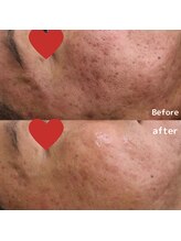 ティンクルホワイト 上尾店/ハーブピーリング施術後