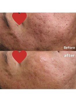 ティンクルホワイト 上尾店/ハーブピーリング施術後