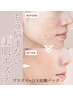 【幹細胞ハーブピーリング  剥離無し】ニキビケア・毛穴黒ずみ・肌質改善