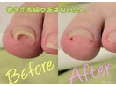 巻き爪補正でいたみ軽減！