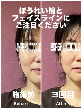 ココロ(CoCoLo)/ビフォーアフター施術前/3回目
