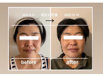 ジーサララ 用賀店(G.Sarara)/ハーブピーリング×カテキン洗浄