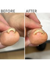 クオッカ(Quokka)/巻き爪ケア